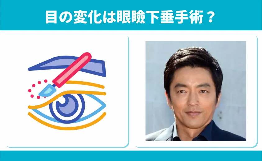 眼瞼下垂手術の影響?